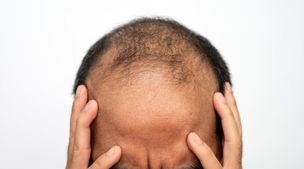 غذای ما و ریزش مو !