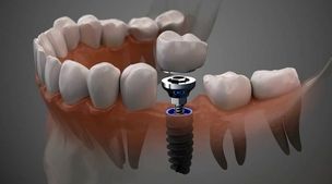 ایمپلنت دندان چیست | بهترین گزینه برای دندان‌های از دست‌ رفته